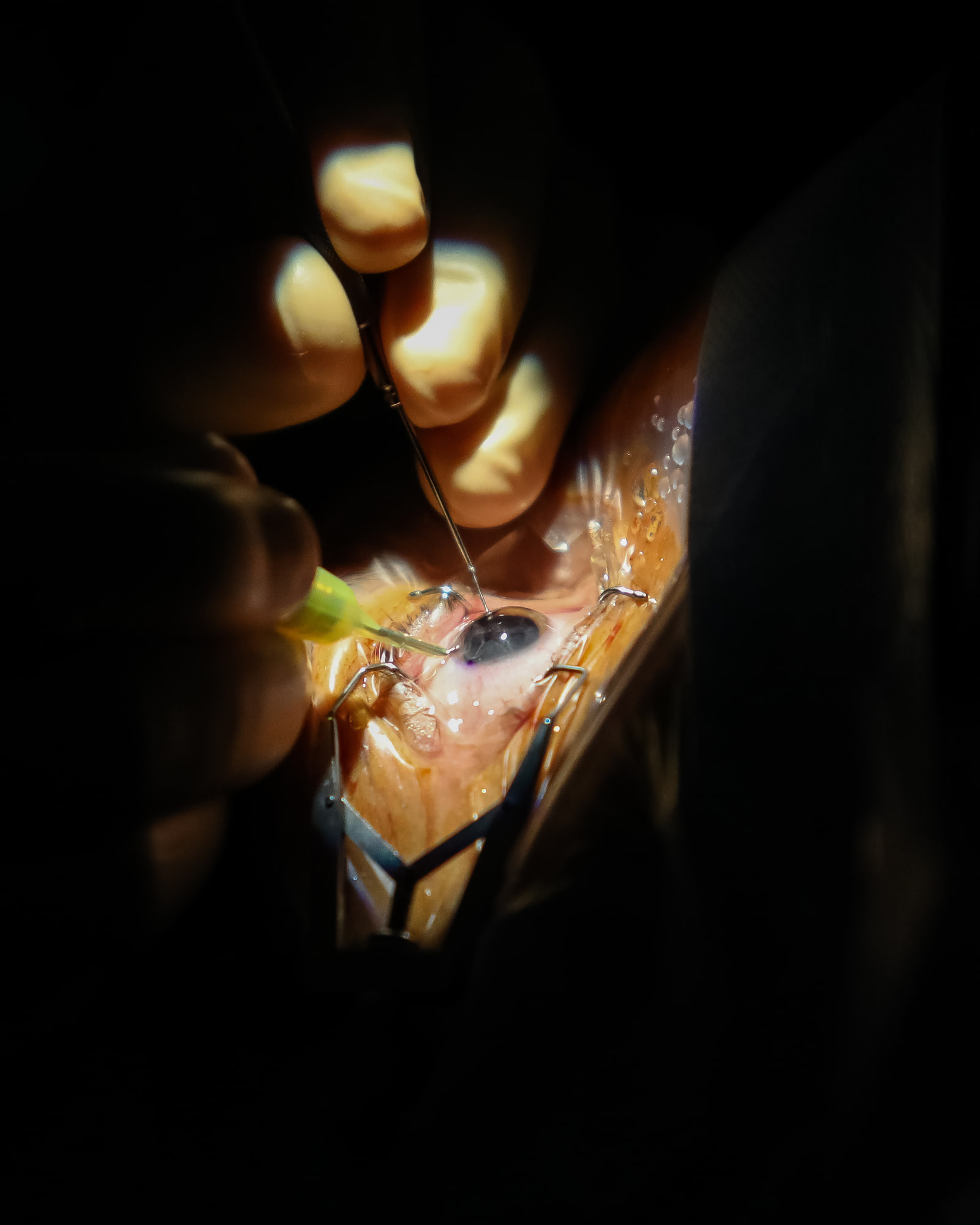 Contexto clínico do tratamento de roturas e buracos da retina na Oftalmologia Algarve